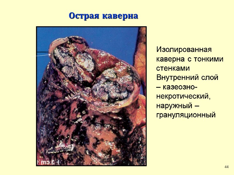 Острая каверна Изолированная каверна с тонкими стенками Внутренний слой – казеозно-некротический, наружный – грануляционный